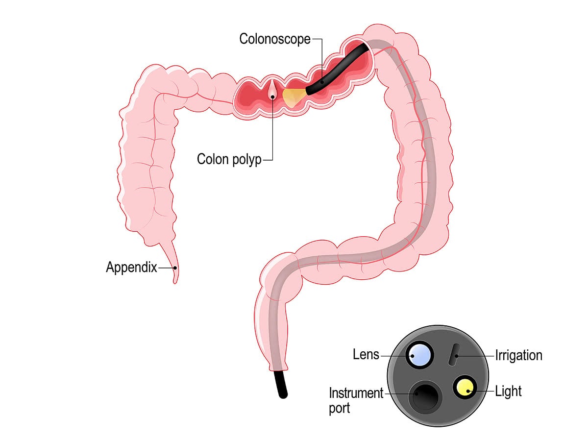 Gastroscopy and colonoscopy 1 jpg A Prof Jaber
