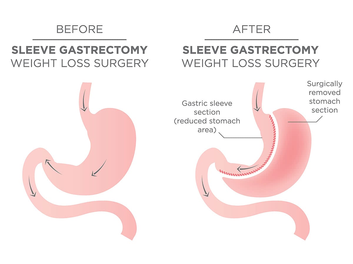 A Prof Jaber Gastric Sleeve Surgery Wollongong