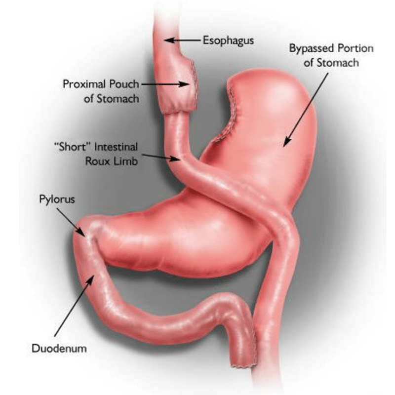 Single Anastomosis Stomach–Ileal Bypass with Sleeve Gastrectomy (SASI-S)